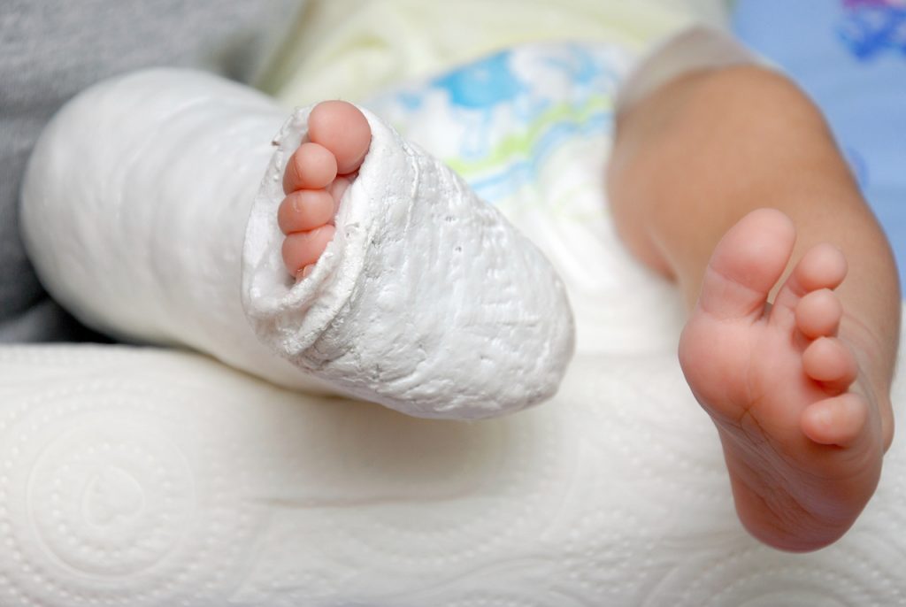 A photo of Club Foot Treatment 